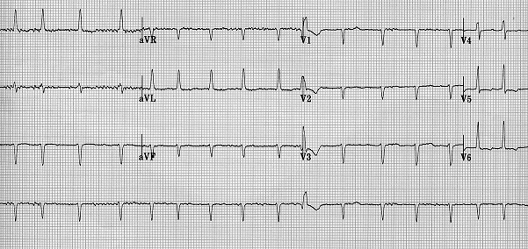Figure 1a : Fibrillation à petites mailles