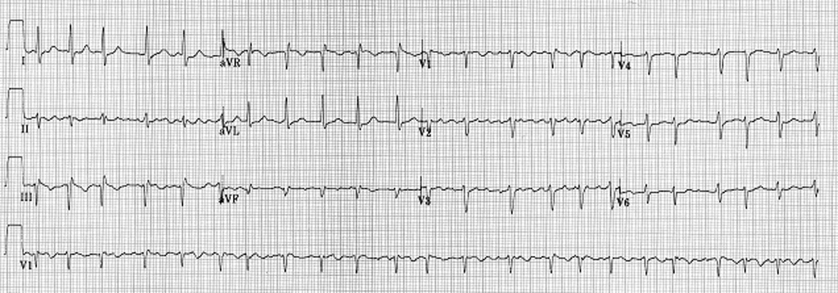 Figure 1b : Fibrillation à grosses mailles