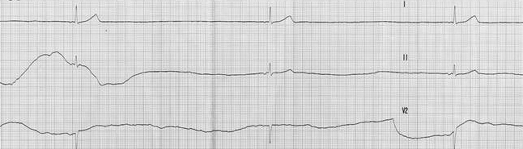 Figure 2 : Dysfonction sinusale avec échappement atrial bas situé