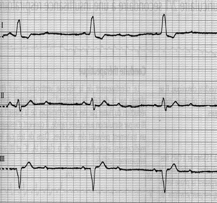 Figure 3 : Exemple de BAV du deuxième degré avec bloc de branche gauche à conduction 2 pour 1