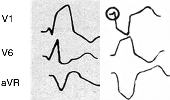 Figure 4 : Morphologies schématiques du QRS dans le boc de branche droite (à gauche) et gauche (à droite)