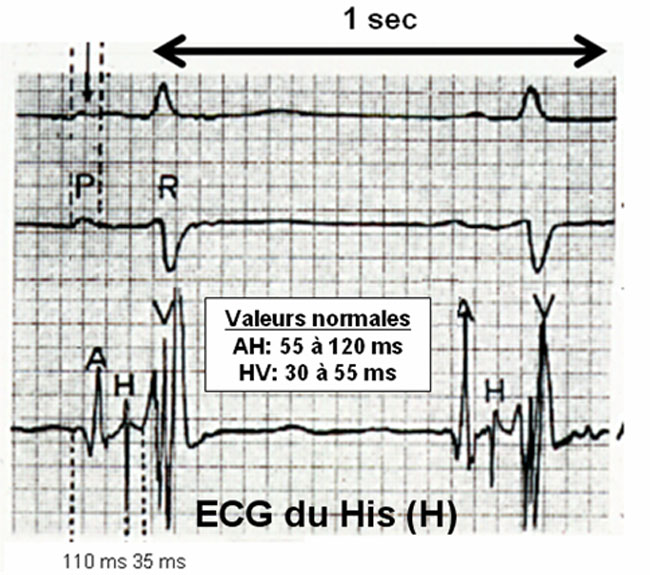 Figure 12 : l’ECG endocavitaire