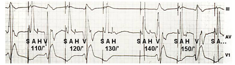 Figure 13 : ECG endocavitaire du faisceau de His sous stimulation auriculaire à fréquence croissante