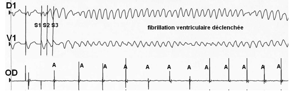 Figure 14 : Stimulation programmée du ventricule droit