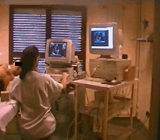 Figure 16 : Enregistrement d’un écho-doppler transthoracique