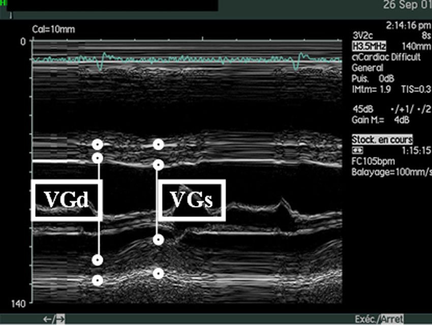 Figure 17 : Echo TM : incidence parasternale grand axe