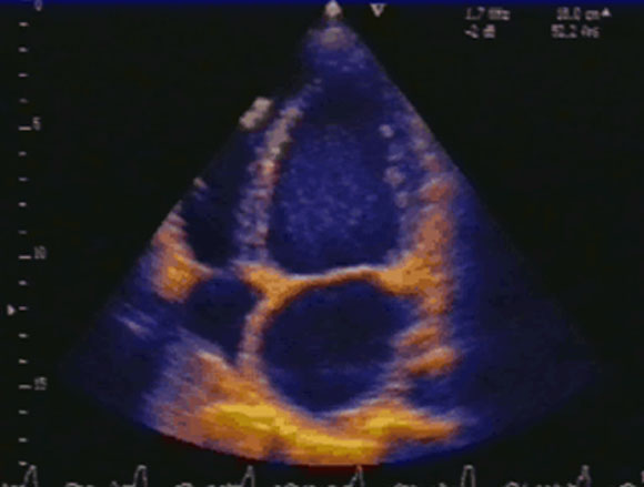 Figure 20 : Echographie bidimensionnelle