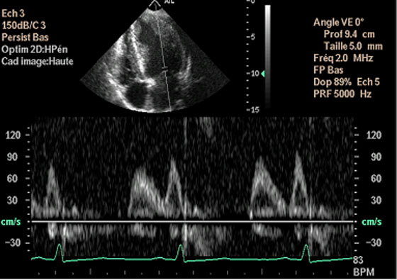 Figure 21 : Echographie-Doppler