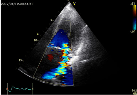 Figure 22 : Echographie-Doppler