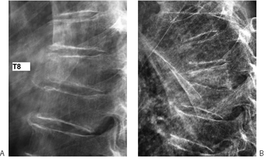 Fig. 10.1. Spondylodiscite tuberculeuse T8-T9. Radiographies de profil du rachis thoracique réalisées à deux mois d’intervalle.