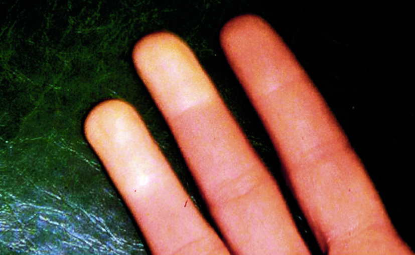 Figure 40.1 : Syndrome de Raynaud