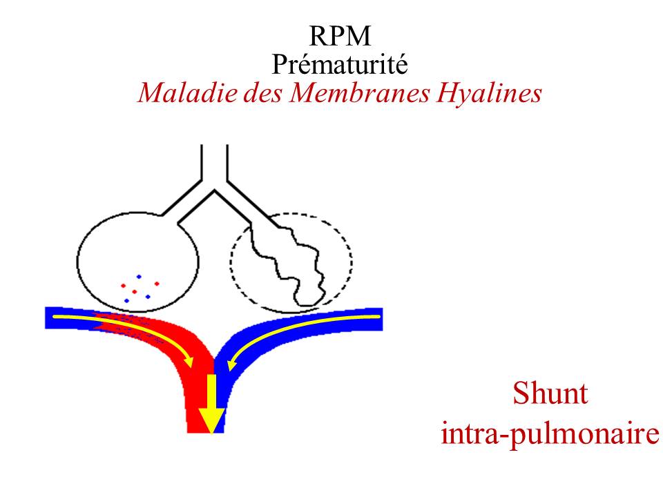 Rupture prématurée des membranes : conséquences fœtales et néonatales.