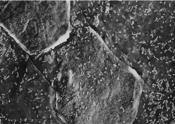 Kératinocyte en voie d’élimination (Microscopie à balayage)
