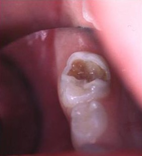 Carie amélo-dentinaire d'une seconde molaire temporaire supérieure droite (55)