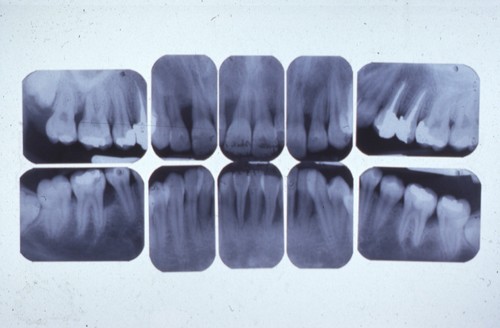 Bilan radiographique d’une parodontite juvénile localisée aux incisives et molaires