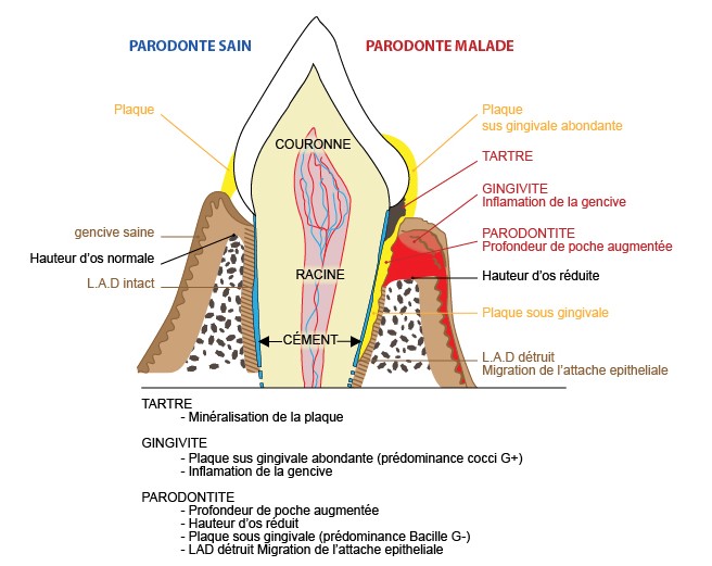 Parodonte sain / parodonte malade